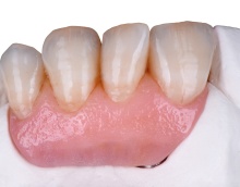 IPS e.max Ceram Gingiva_T.Michel_Deutschland