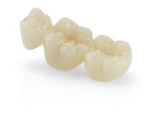 IPS_e.max_ZirCAD_MT_Multi_bridge_chairside glaze_stains