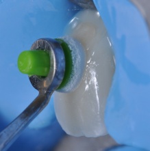 adhesive cementation_Koubi